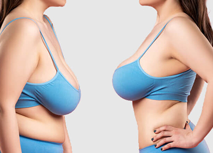 Cosmetic Breast Surgery in India