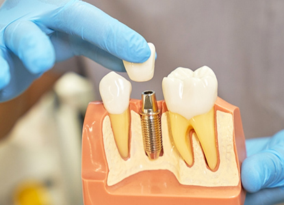 Advanced Dental Implant Solutions Provided