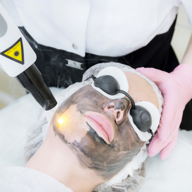 Laser for Acne and Scars