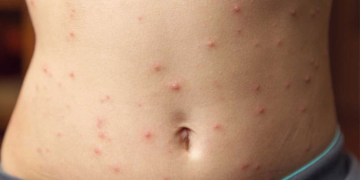 Skin Allergies