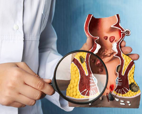 Ayurvedic Treatment for Piles and Fistula in Delhi Gate Agra